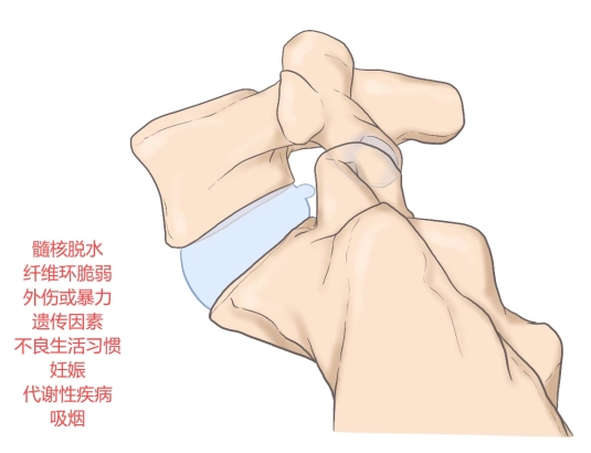 图二：腰椎L5-S1突出症矢状位及病因示意图